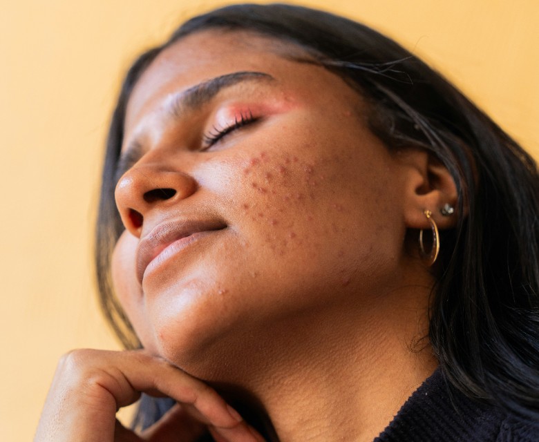 Acne Conditions Head Rr