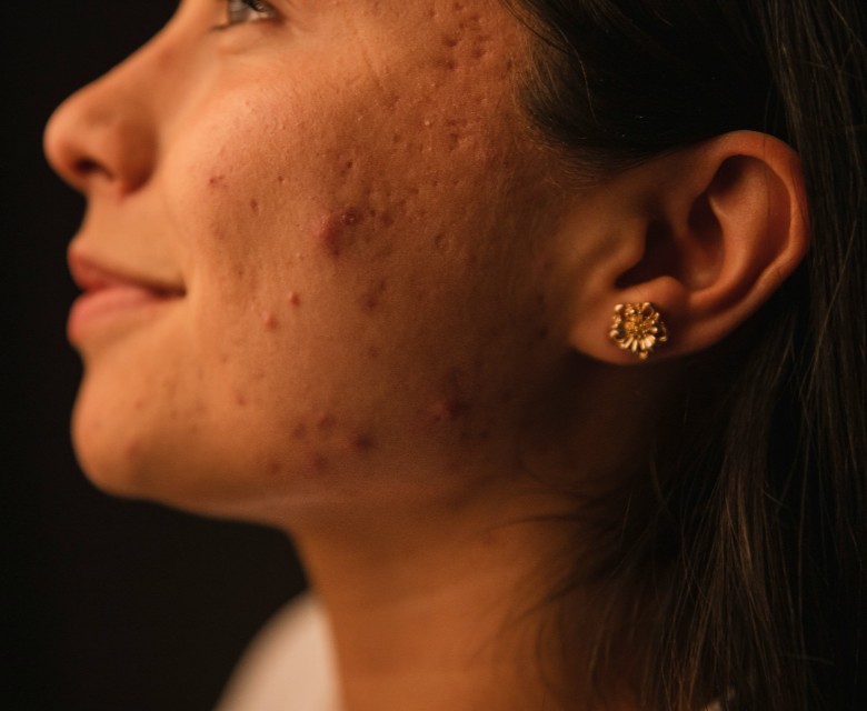 Acne Scarring Conditions Head Rr