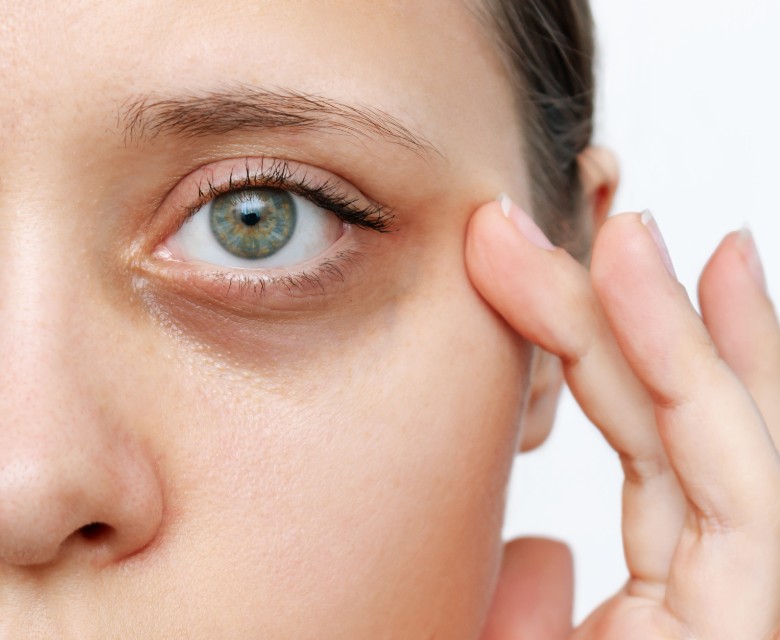 Dark Circles Conditions Head Rr