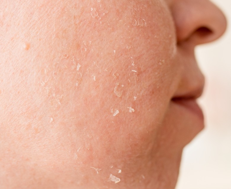 Dull Dry Skin Conditions Head Rr
