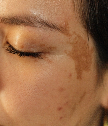 Hyperpigmentation Conditions Feat Rr
