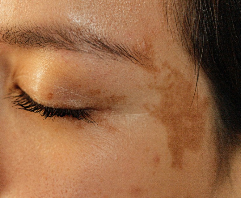 Hyperpigmentation Conditions Head Rr
