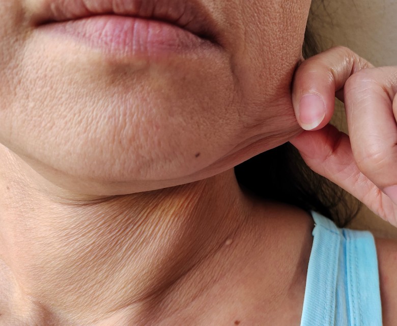 Loose or Sagging Skin Conditions Head Rr
