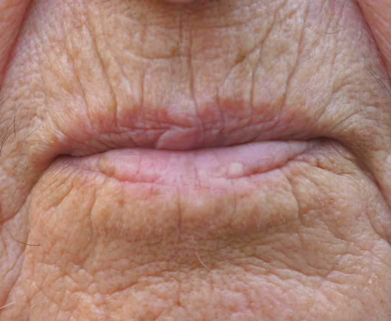 Upper Lip Lines Conditions Head Rr