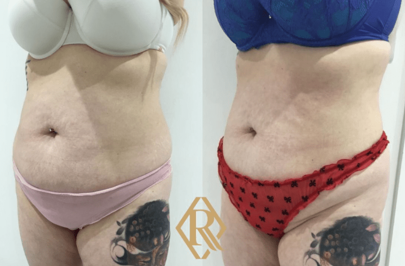 Cristal Pro Fat freezing in leeds