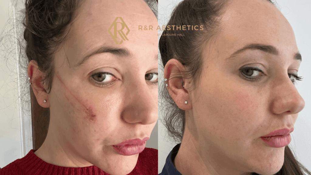 before and after scar treatment