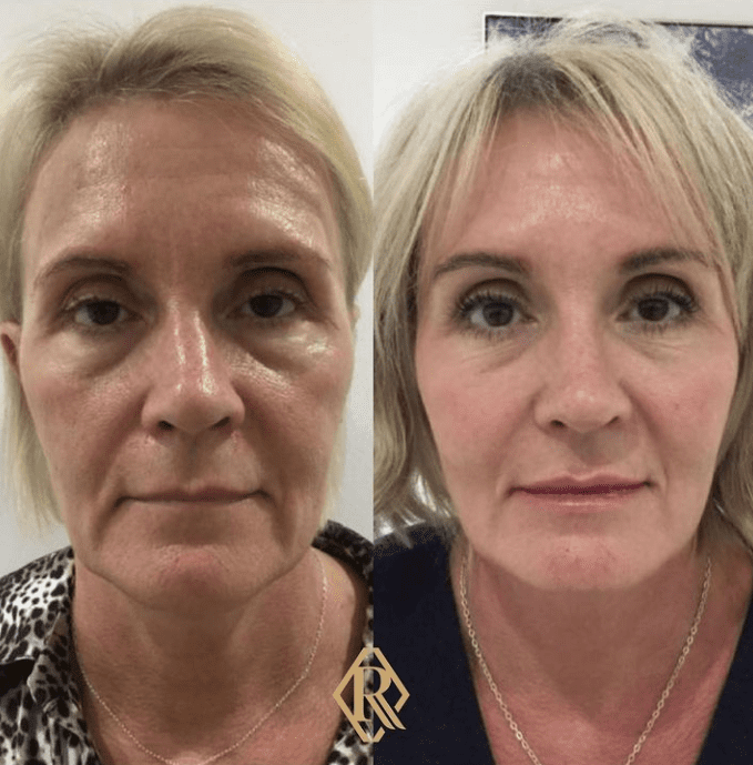 before and after fillers garforth leeds